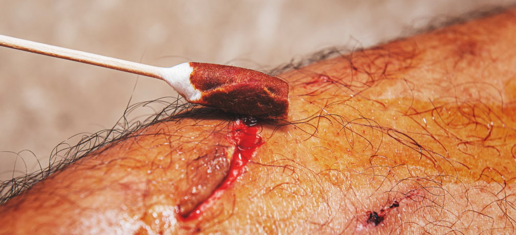 Open cut that needs stitches